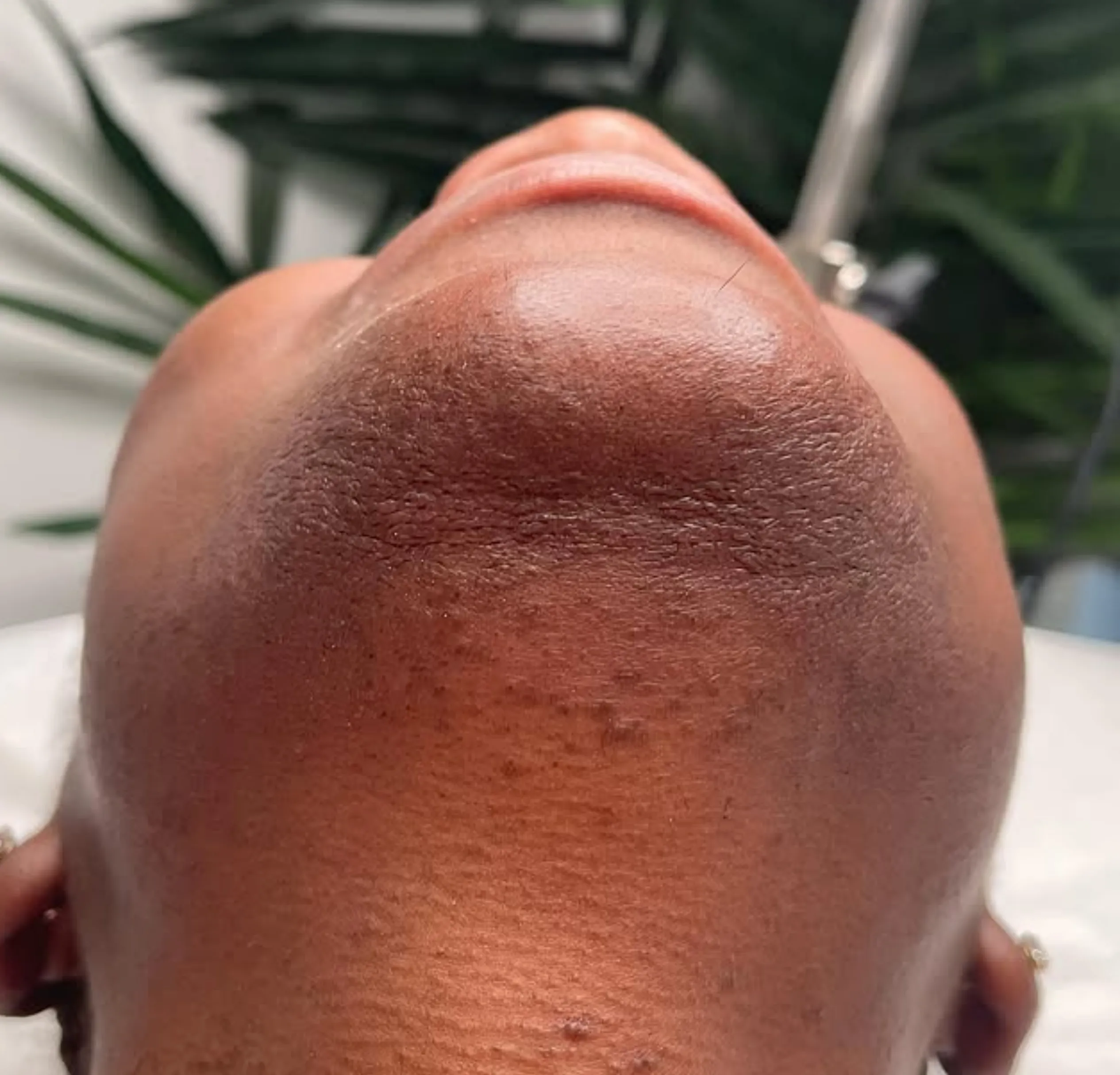 start laser hair removal business